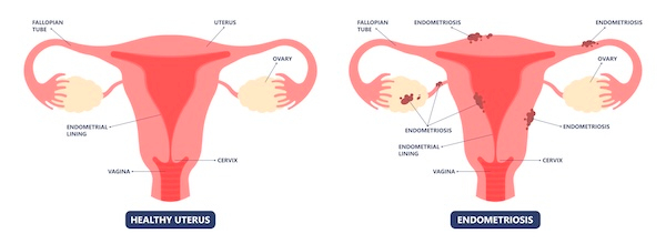Graphic-of-endometriosis
