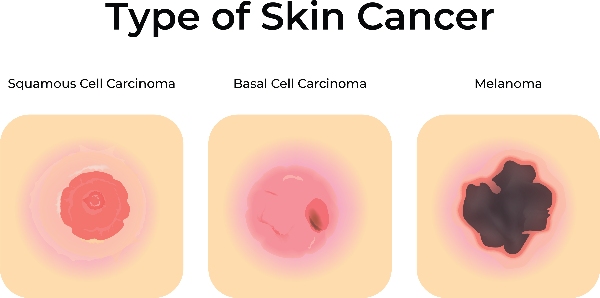 Spotting the Signs of Skin Cancer