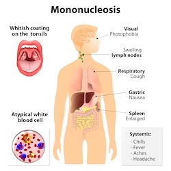 Managing Mononucleosis in Idaho