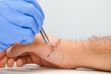 A doctor stitching up cut on mans hand