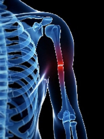 Understanding Broken and Fractured Bones